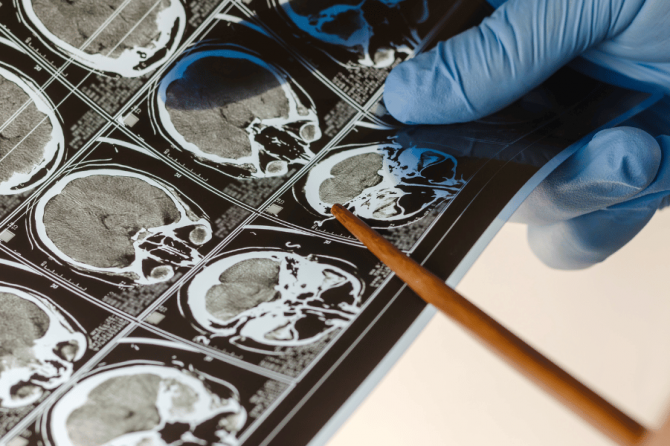 Kviečiame registruotis pas gydytojos neurochirurgus